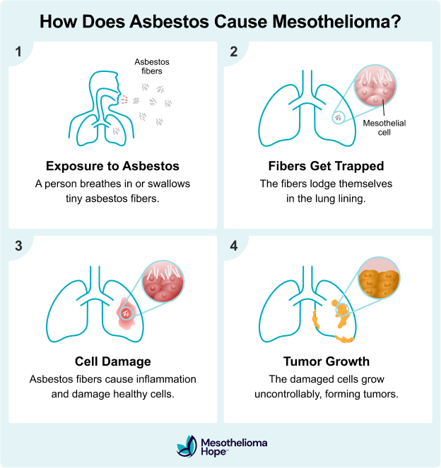 Infographic by Mesothelioma Hope showing how asbestos causes mesothelioma. The graphic illustrates four different phases — 1: Exposure to asbestos, 2: Fibers get trapped, 3: Cell damage, and 4: Tumor growth.